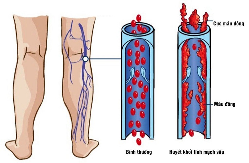 Bệnh lý huyết khối tĩnh mạch sâu (DVT)